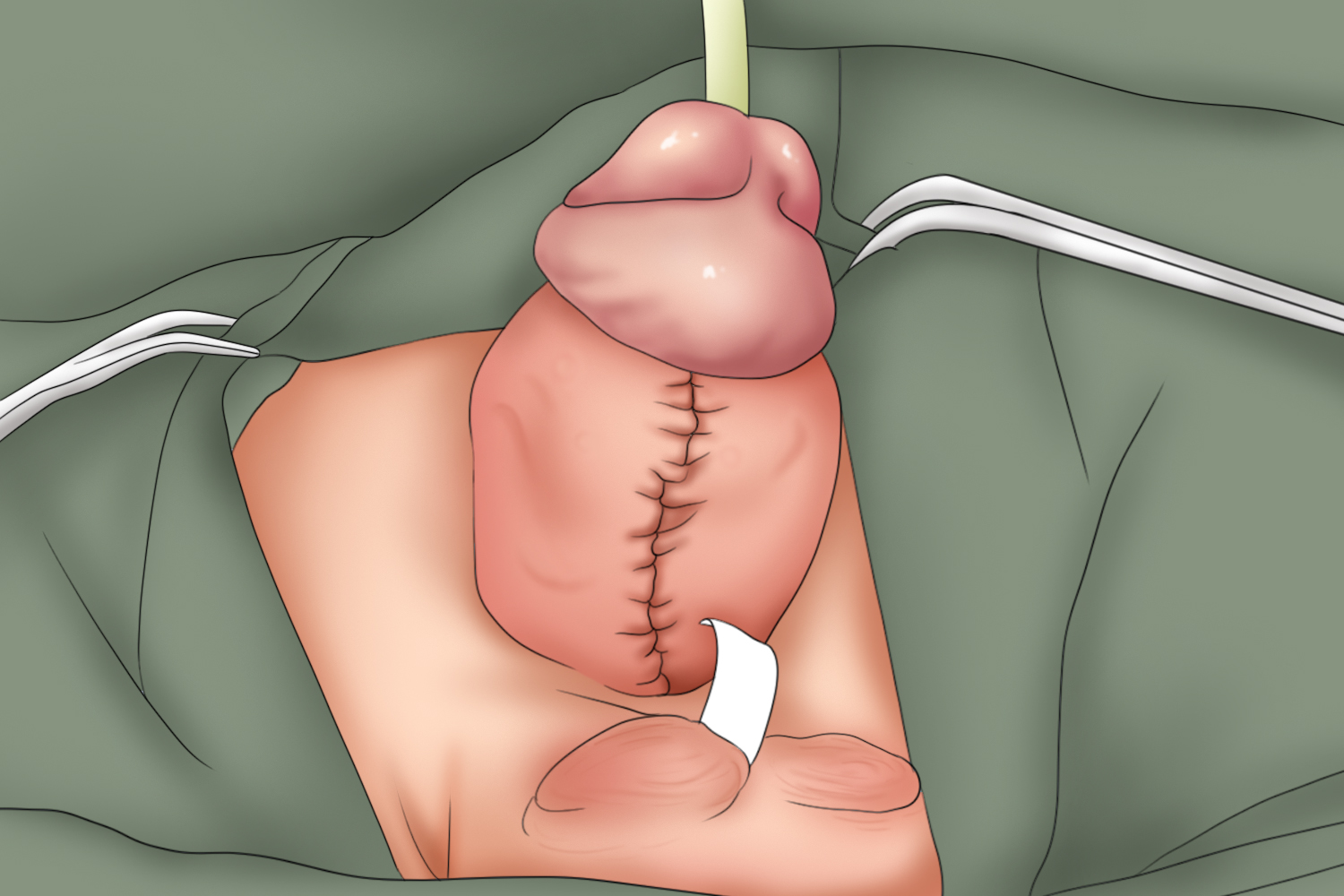 蹼状阴茎手术缝合图 蹼状阴茎手术缝合图