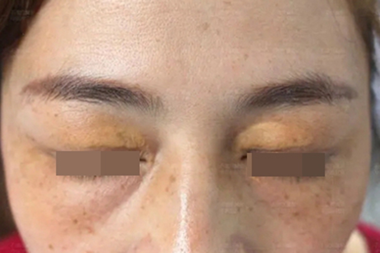 结节性黄瘤眼睑症状图