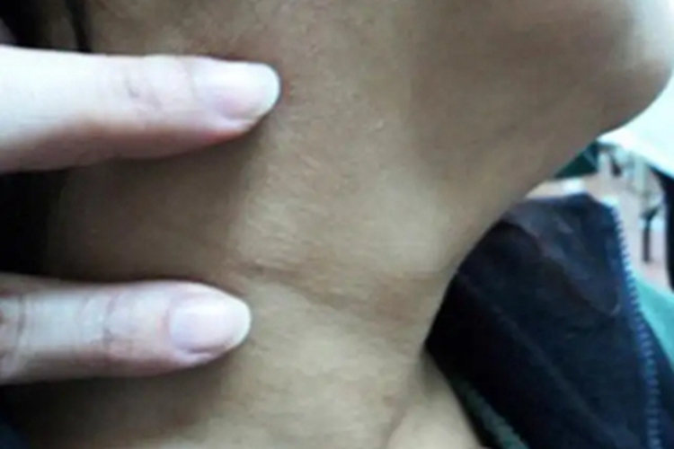 皮肤猪囊虫病颈部结节图