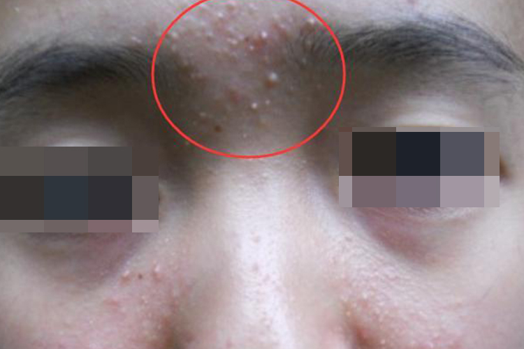 脸部痤疮丘疹图