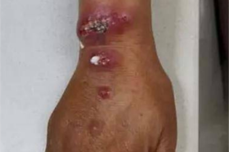 海鱼分枝杆菌感染手腕结节溃烂图 海鱼分枝杆菌感染手腕结节溃烂图