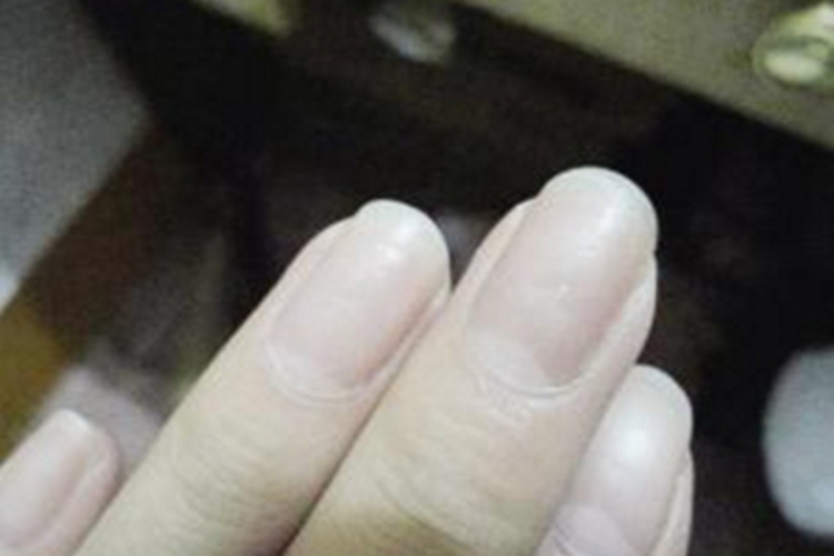 慢性苯中毒手指甲发白图