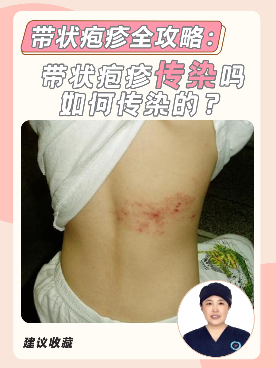带状疱疹全攻略:带状疱疹传染吗,如何传染的?