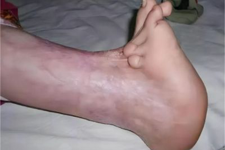 缺血性肌挛缩脚部症状图 缺血性肌挛缩脚部症状图