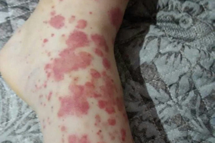 皮下出血红斑相互融合图