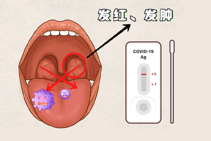 扁桃体发炎做抗原检测会呈阳性吗.jpg