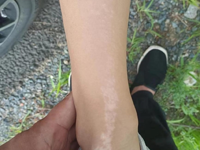 线状苔藓脚踝长有线状白斑图.jpg