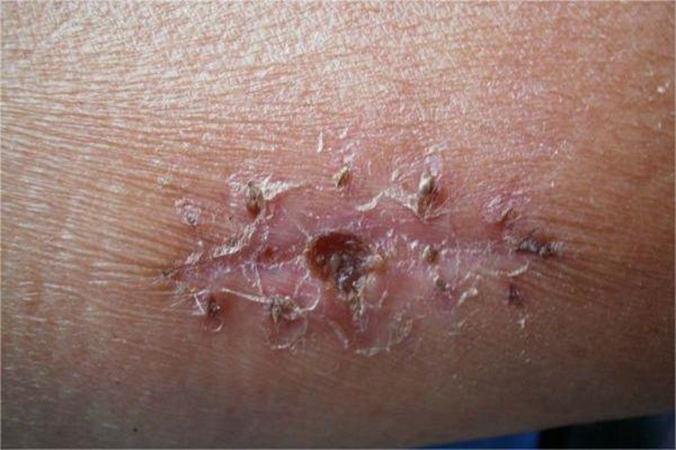 溃疡性皮肤结核小腿脱皮图 溃疡性皮肤结核小腿脱皮图