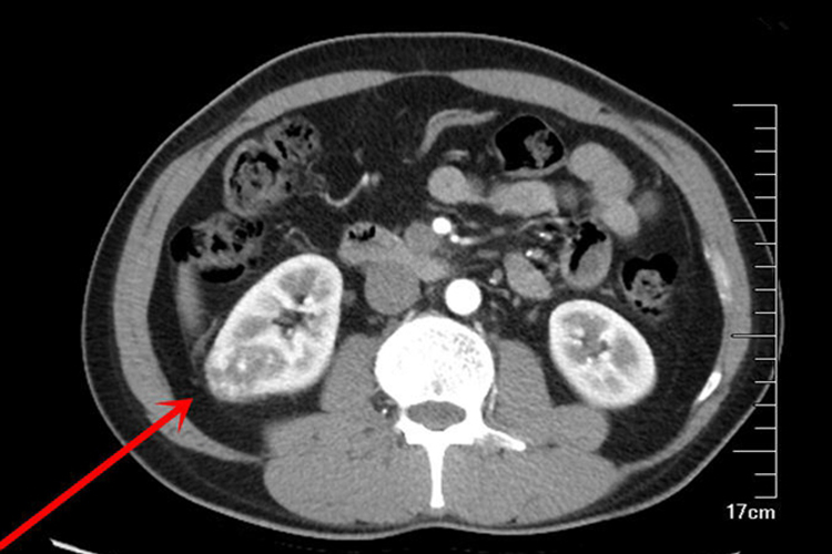 恶性肾肿瘤图