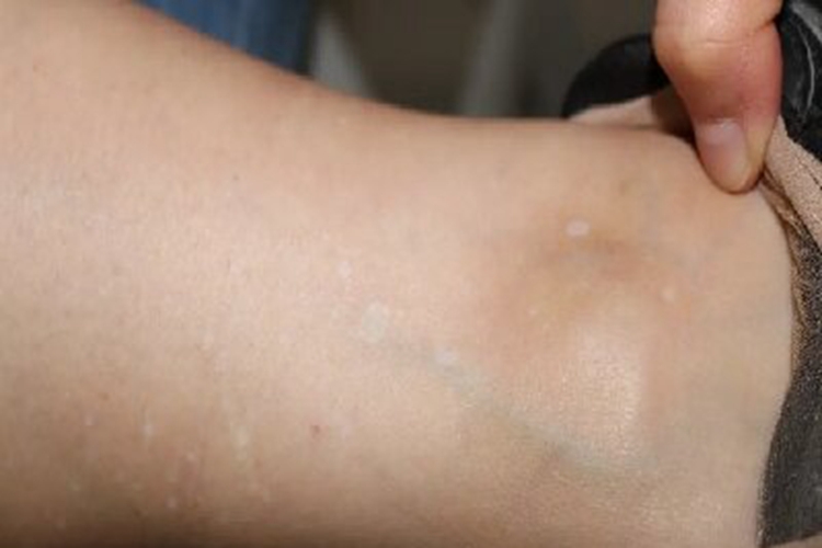 特发性点状色素减退斑脚踝白斑图