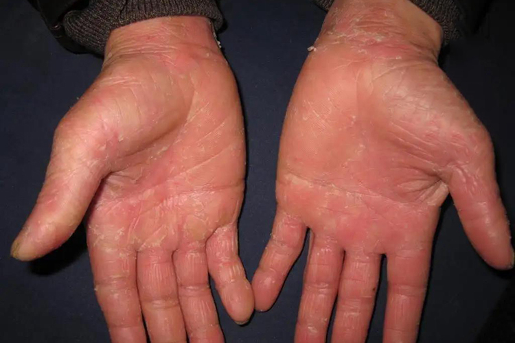 手掌进行性对称性红斑角皮症图