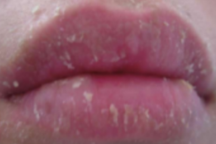 慢性唇炎唇部脱屑图片