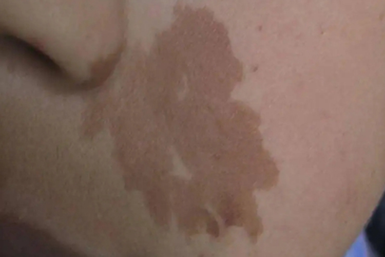 咖啡斑脸上有大片深棕色斑图