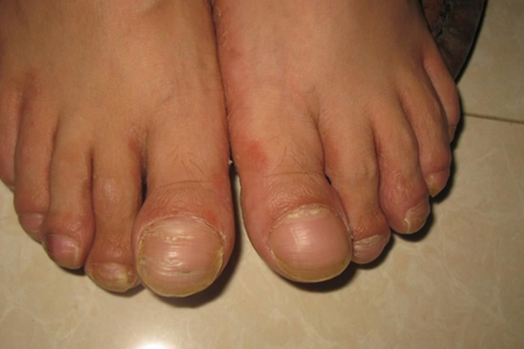 脚趾杵状指图 脚趾杵状指图