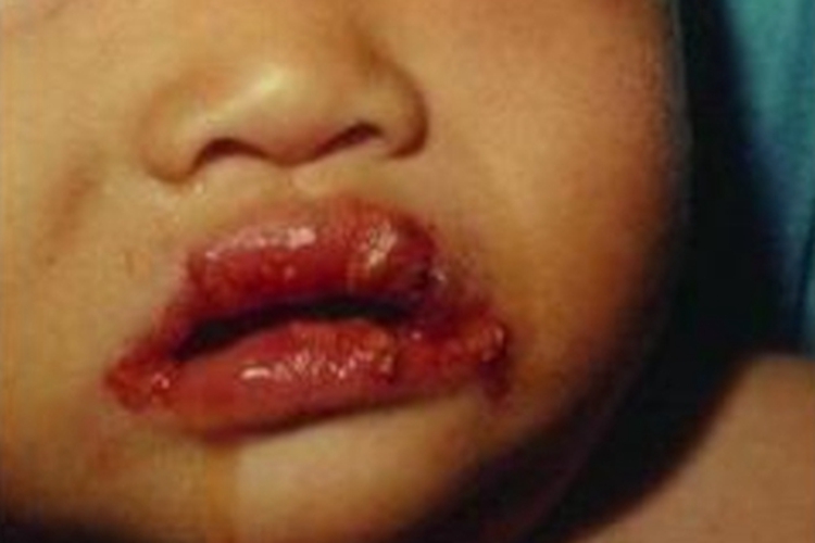 维生素B2缺乏症嘴唇糜烂图 维生素B2缺乏症嘴唇糜烂图