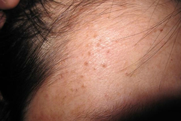 毛囊角化病症状图 毛囊角化病症状图