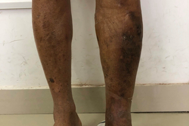 下肢静脉曲张症状图 下肢静脉曲张症状图