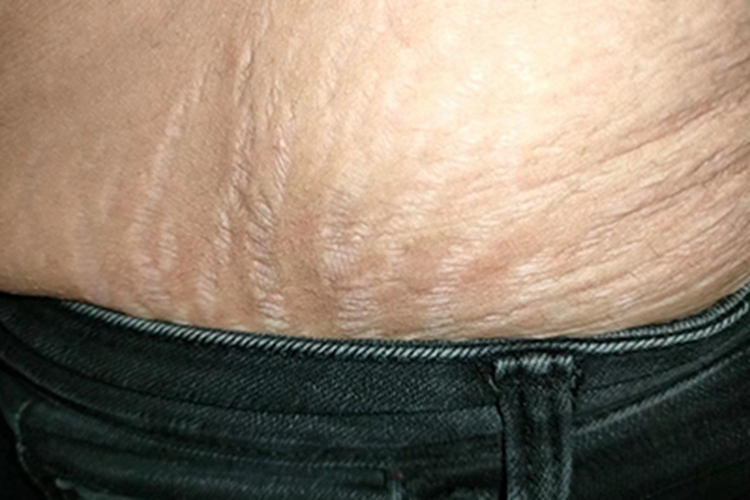 腰部萎缩纹症状图