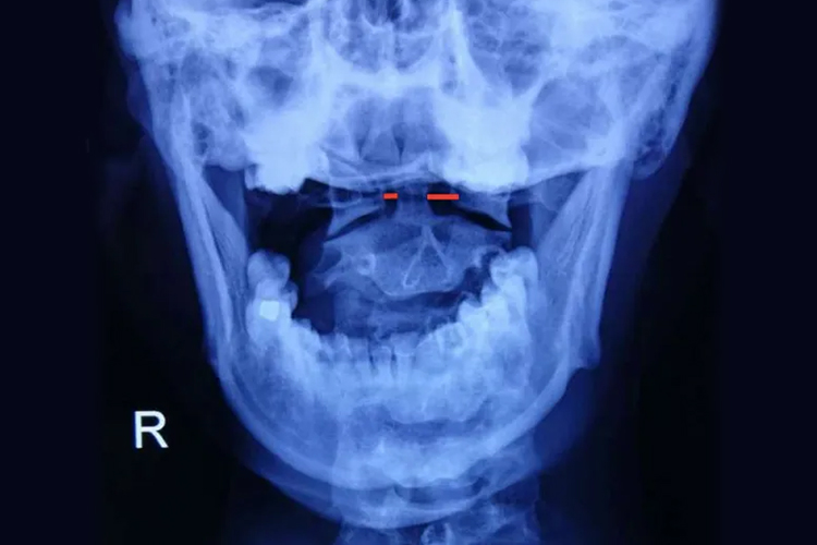 寰枢椎脱位图 寰枢椎脱位图