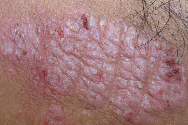 苔藓样副银屑病图 苔藓样副银屑病图
