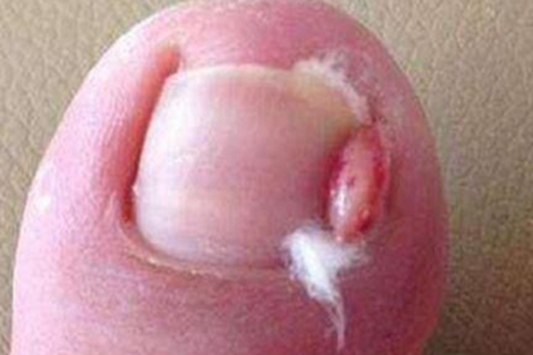 甲床炎疙瘩图
