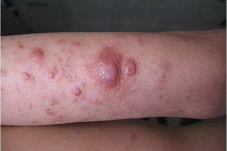 中间界线类麻风斑疹图
