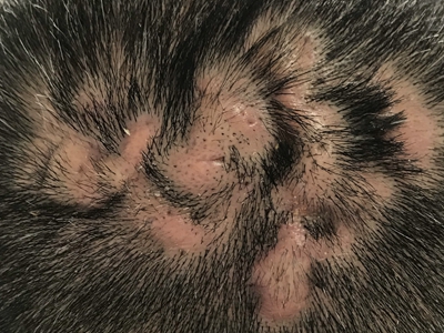 部分秃发性毛囊炎患者的头皮有明显的皮损,属于脓疱愈合后留下的萎缩