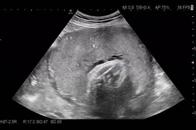轮状胎盘超声影像图