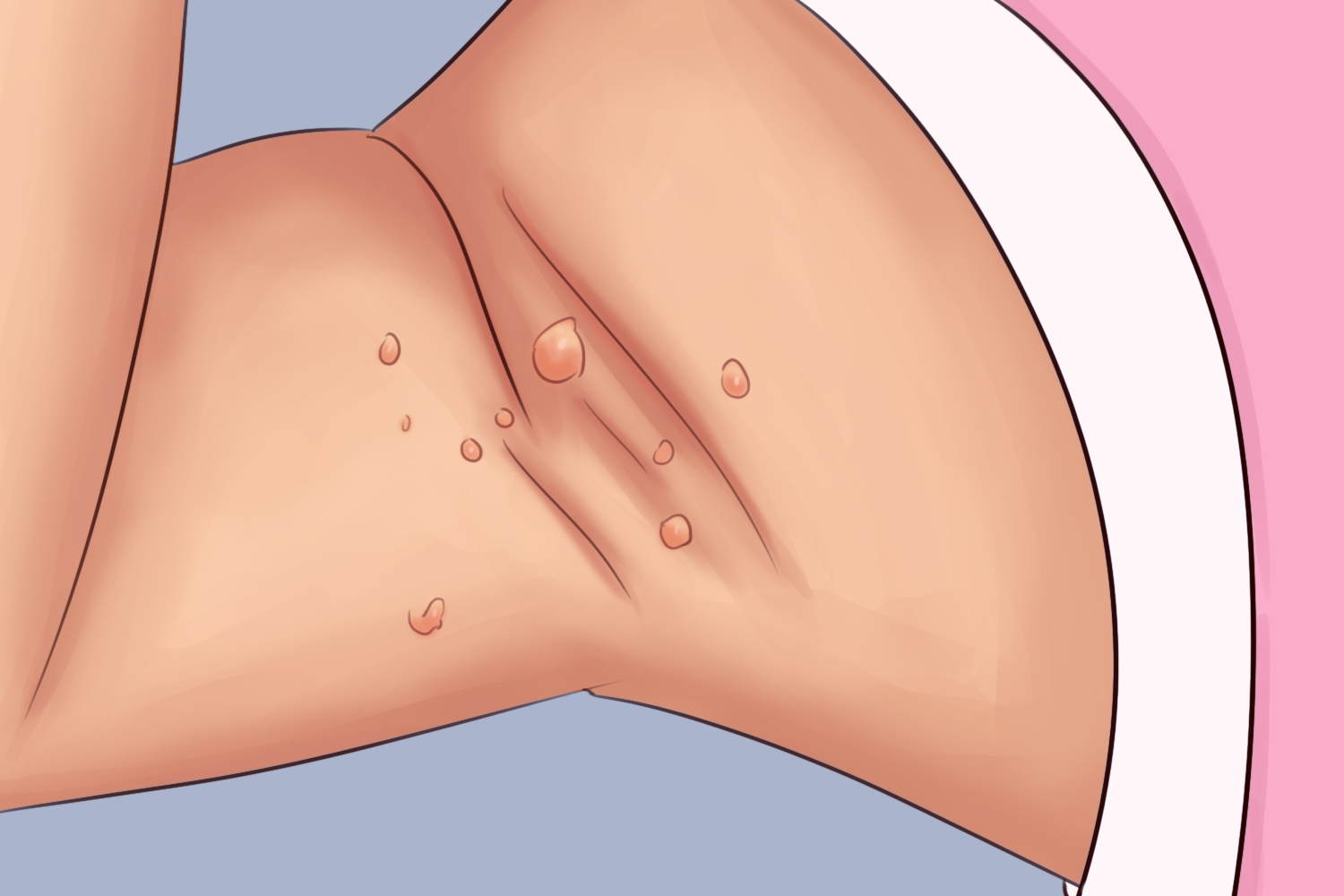 腋窝下寻常疣图