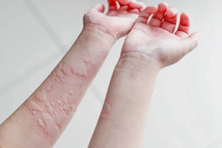 荨麻疹胳膊症状图