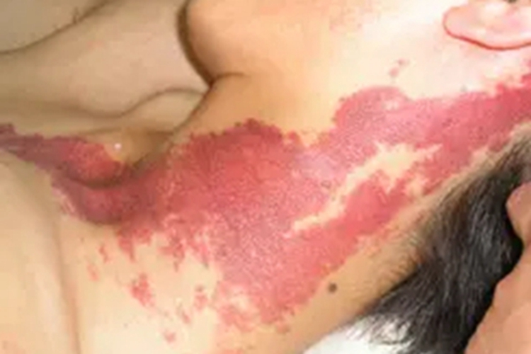 鲜红斑痣侧颈症状图