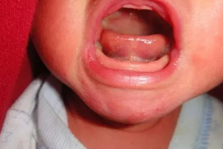 舌系带过短像没有舌系带图