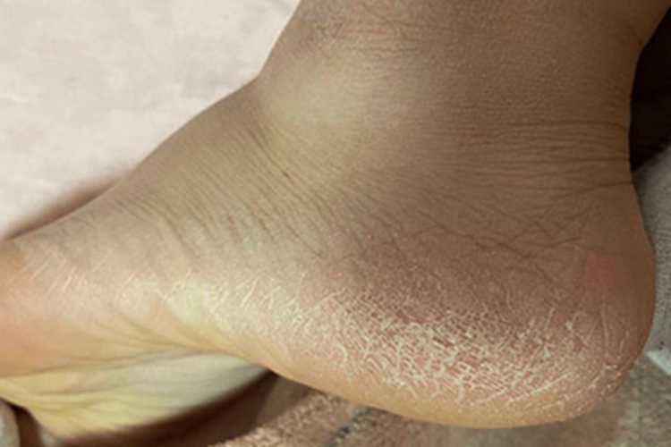 足部皲裂症状图 足部皲裂症状图