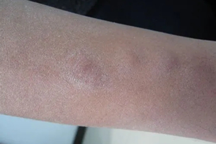 结节性结核性静脉炎胳膊结节图 结节性结核性静脉炎胳膊结节图