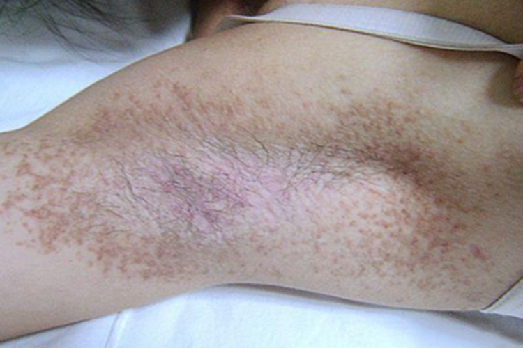 持久性豆状角化过度病腋窝症状图