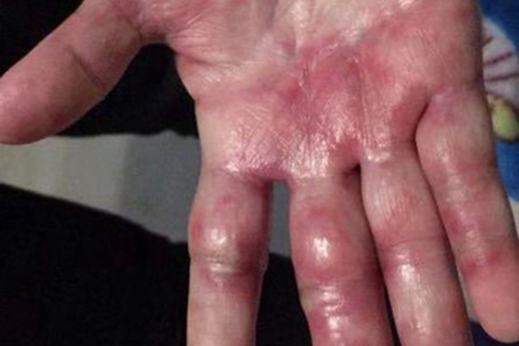 手足综合征红肿图