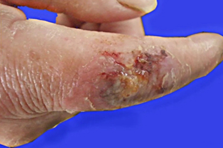 淋巴管型皮肤型孢子丝菌病化脓图 淋巴管型皮肤型孢子丝菌病化脓图