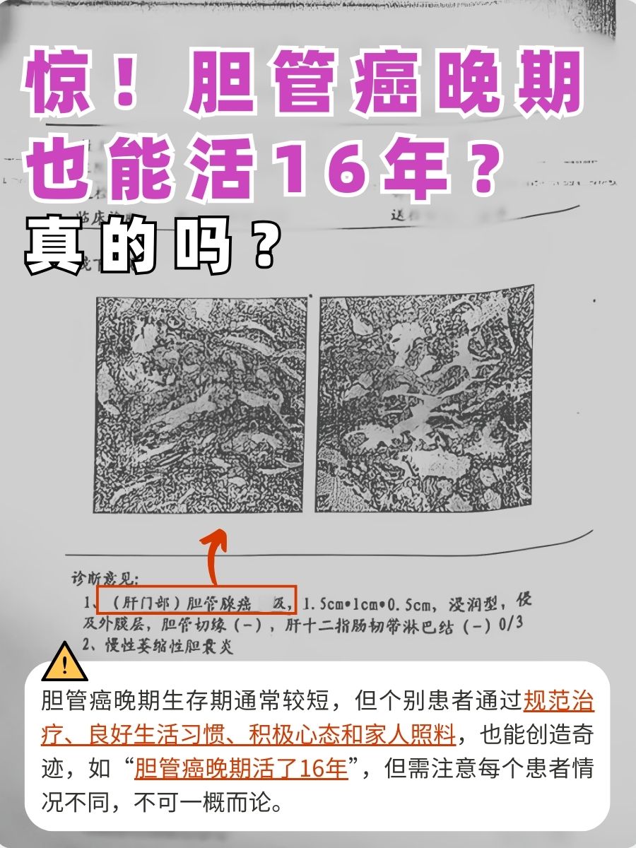 惊！胆管癌晚期也能活16年？真的吗？