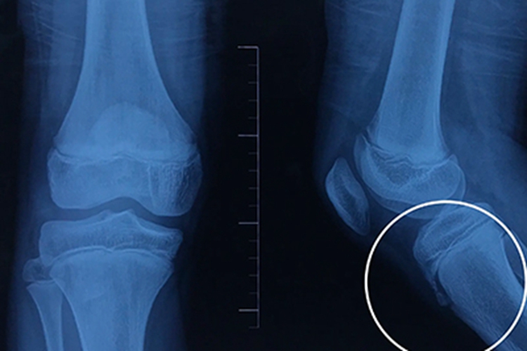 胫骨结节炎X线图 胫骨结节炎X线图