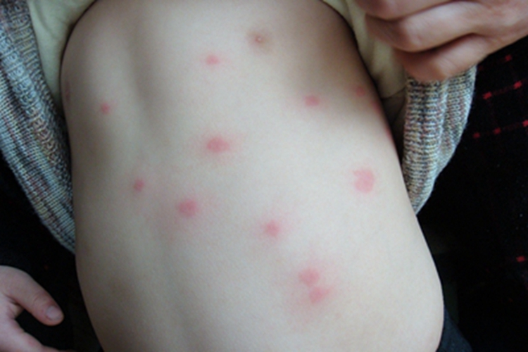 丘疹性荨麻疹背部症状图