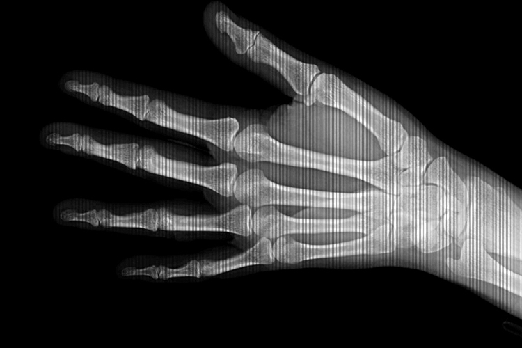 正常左手手腕X光片图