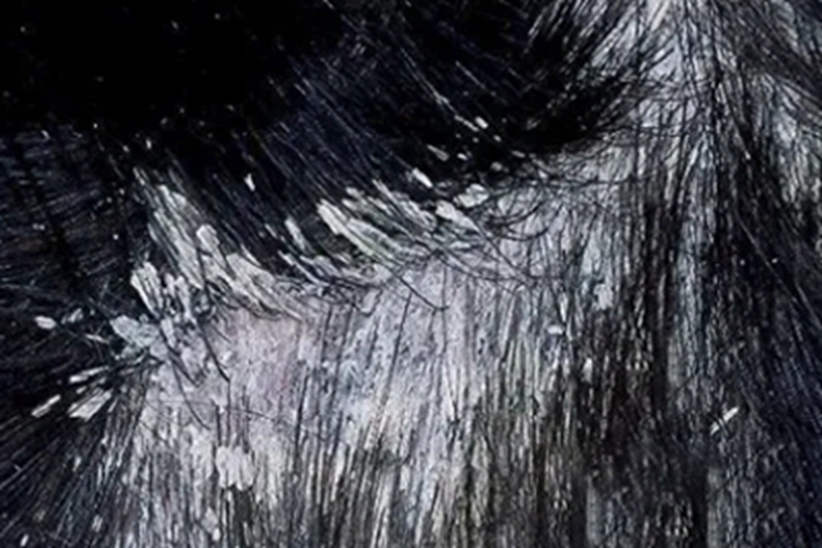 石棉状糠疹头皮脱屑图