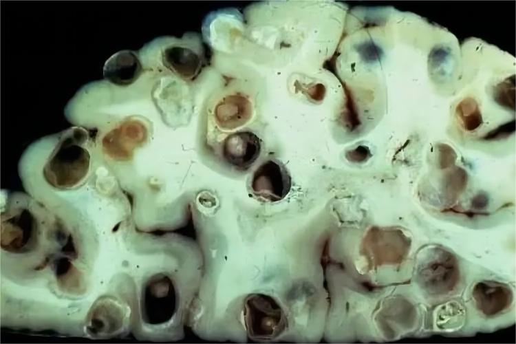 脑囊型棘球蚴病图