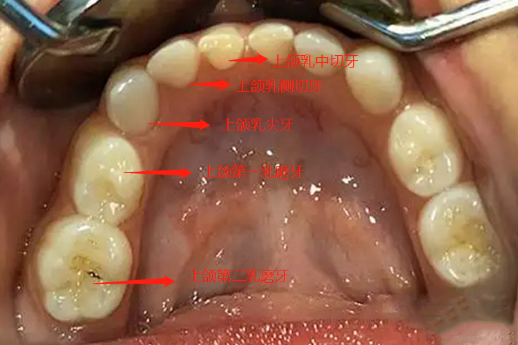 上颌乳牙图