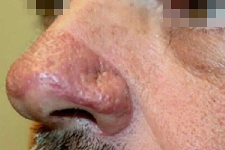 面部肉芽肿鼻部症状图