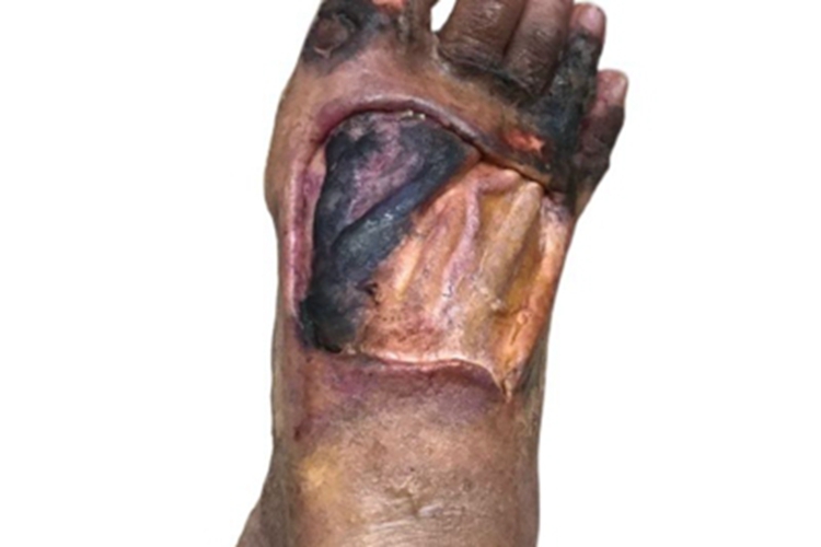 电弧烧伤脚背烧焦图 电弧烧伤脚背烧焦图