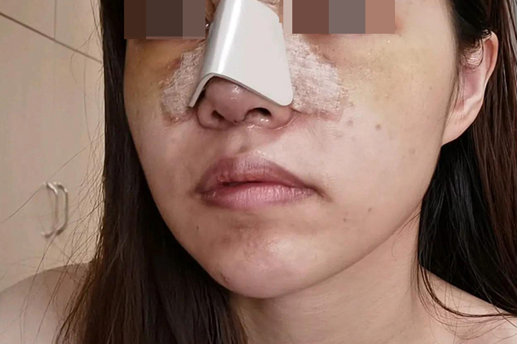 鼻骨骨折术后包扎固定图 鼻骨骨折术后包扎固定图