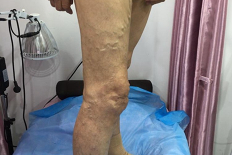 右侧大隐静脉曲张图