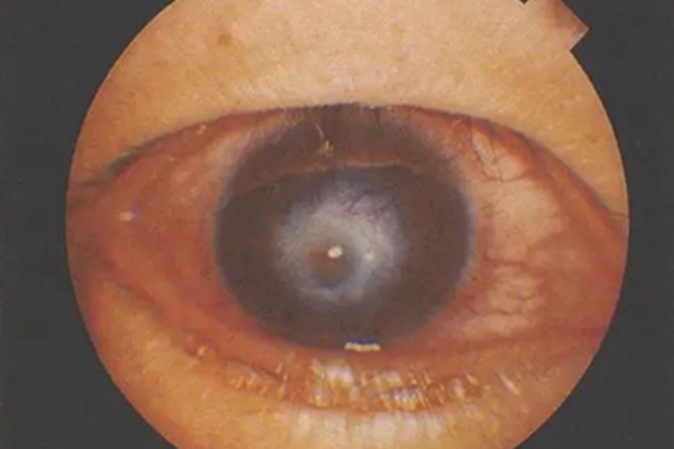 瘢痕性睑内翻眼部症状图