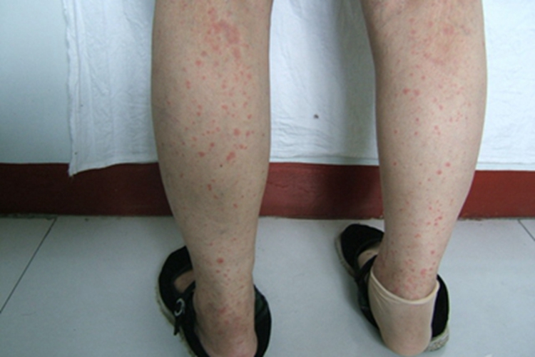 夏季皮炎小腿症状图 夏季皮炎小腿症状图